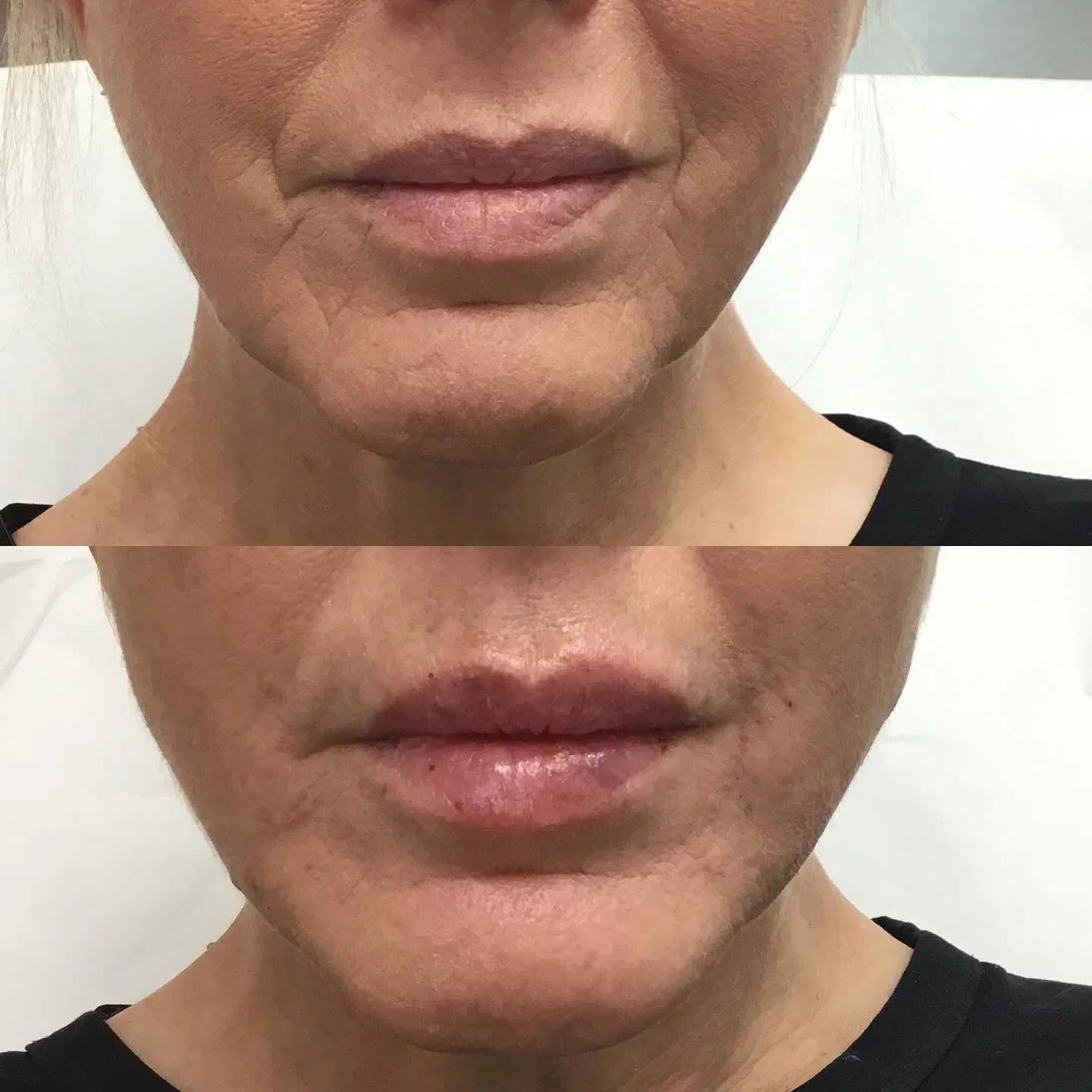 Perioral lines, chin and lip filler